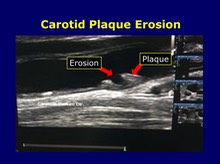 Carotid Plaque Erosion