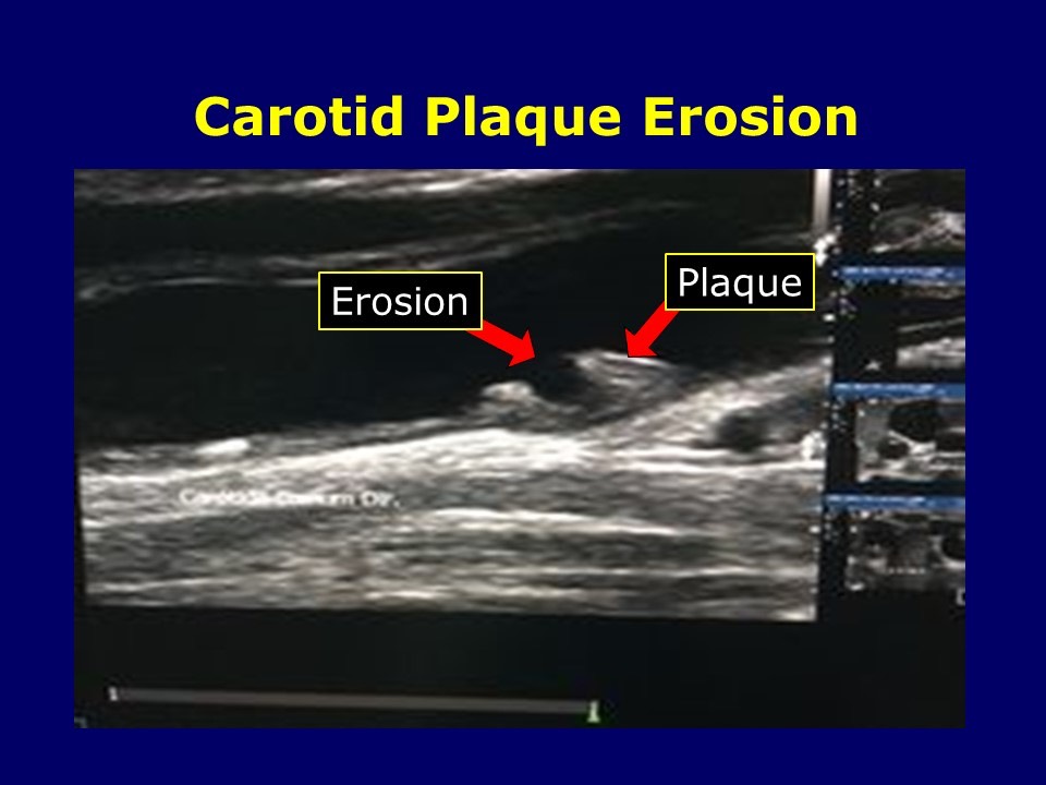 Carotid Plaque Erosion