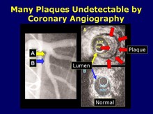 Coronary arteriogram Not Detecting Plaque