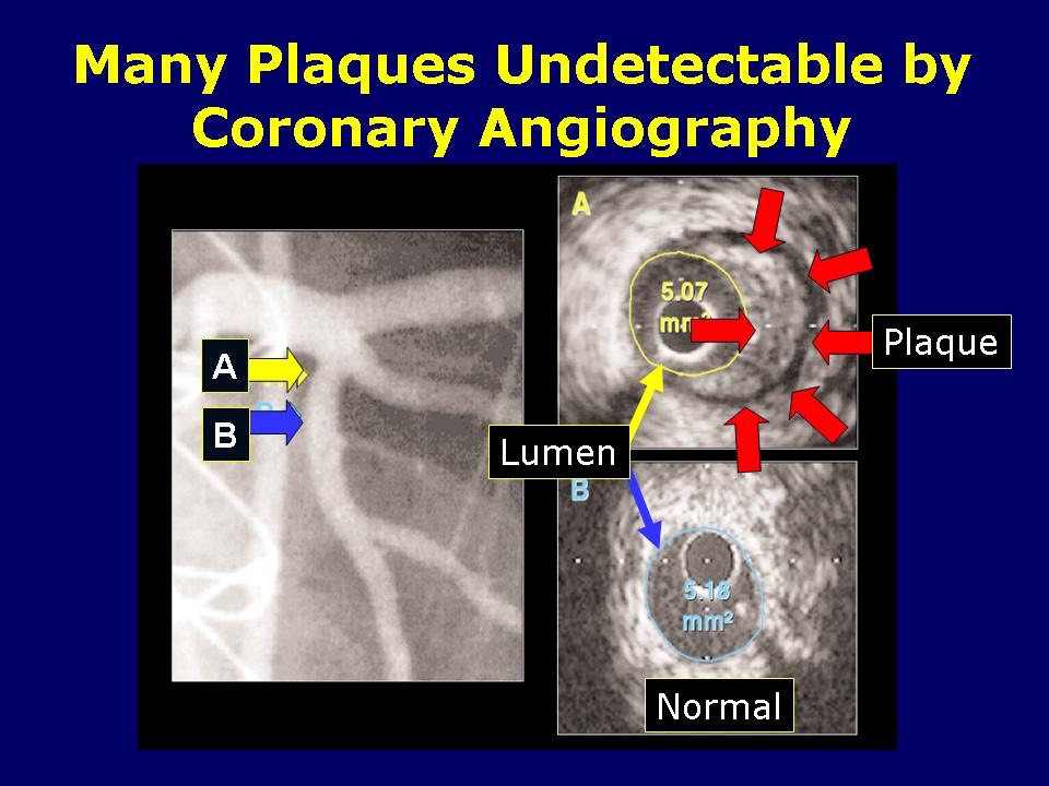 Coronary arteriogram Not Detecting Plaque