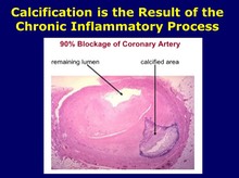 Coronary Calcification Pathology Slide