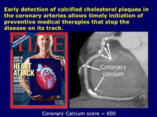 Coronary Calcium Score