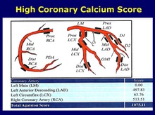 High Coronary Calcium Score