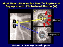 IVUS vs Arteriogram