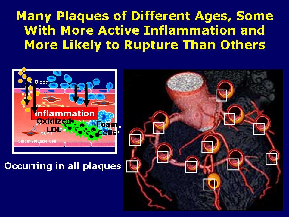 Many Plaques, Some More Likely To Rupture Than Others Advanced
