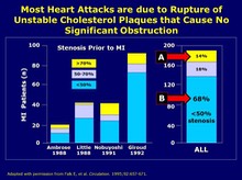 Most Heart Attacks not due to severe obstruction