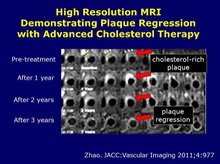 MRI Plaque Regression