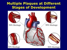 Multiple Plaques at Different Stages of Development