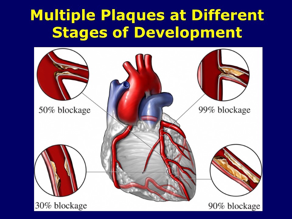 Multiple Plaques at Different Stages of Development Advanced