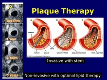 Plaque Therapy
