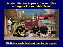 Sudden Plaque Rupture Caused This