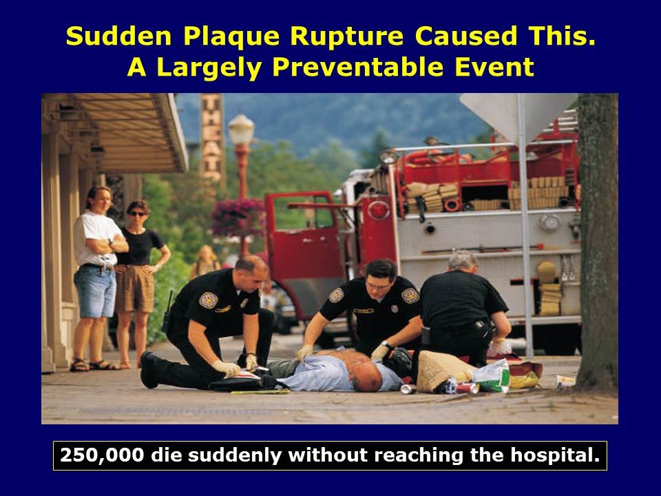 Sudden Plaque Rupture Caused This