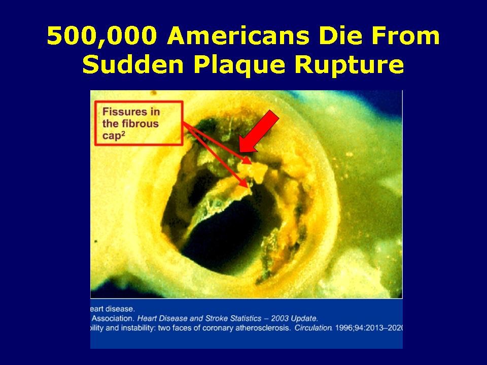 Sudden Plaque Rupture