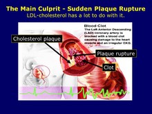 The Main Culprit - Sudden Plaque Rupture