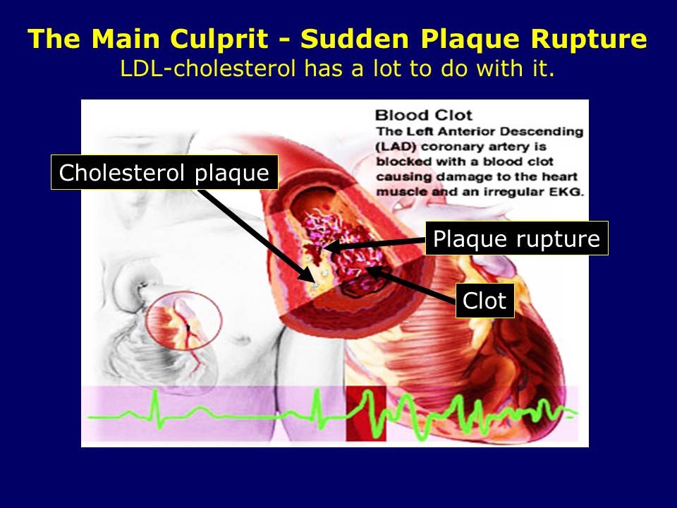 The Main Culprit - Sudden Plaque Rupture
